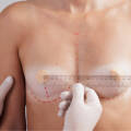MIA Femtech Before and After: How to Judge Natural Results, Scars, and Shape